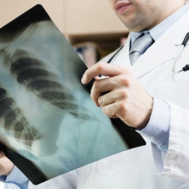 Especialistas dan a conocer las necesidades de financiación en investigación en el cáncer de pulmón con motivo del Día Mundial de la Investigación en Cáncer del próximo domingo / Shutterstock - Banco de imágenes