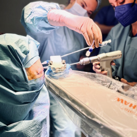 Una imatge d'una operació amb la nova tècnica amb cirurgia làser per tractar un tumor de cervell molt agressiu.