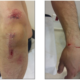 Heridas provocadas a un camarero tras una agresión homófoba y racista en Madrid./Público