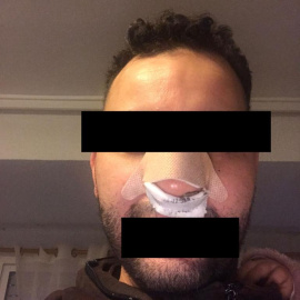 Imagen de las lesiones sufridas por el joven tras la paliza en las inmediaciones de la discoteca Mya de València.