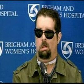 Comparece el primer trasplantado total de cara de EE.UU