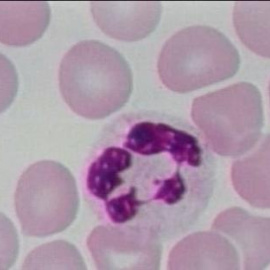 Un grupo de investigadores españoles consigue descifrar el genoma de la Leucemia Linfática Crónica