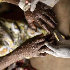 Un paciente con mpox recibe tratamiento en el hospital Kavumu en Karanrhada, República Democrática del Congo, el 3 de septiembre de 2024