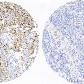 Tejido de mama de un paciente con recaída, con marcadores de fosforilación activa (color marrón izquierdo), en comparación con el tejido mamario de un paciente sin recaída y que no tiene estos marcadores activos (derecha). CNIO