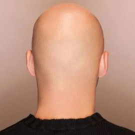 Imagen de un hombre con calvicie (Archivo).