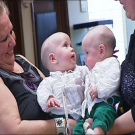 Vall d'Hebron separa a dos siamesas