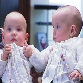 Dos siamesas inician una nueva vida por separado