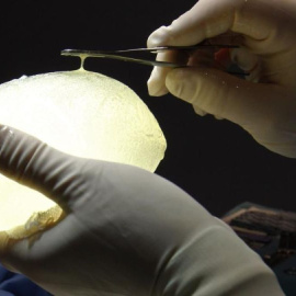 Un cirujano sujeta un implante de silicona PIP. Reuters