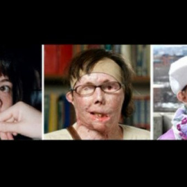 Sexto transplante completo de cara en EEUU