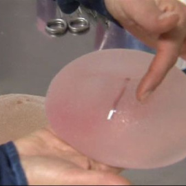 Sanidad recomienda la retirada de todas las prótesis PIP