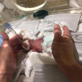 Dan de alta en Japón al bebé más pequeño del mundo, nacido con 268 gramos./ EFE