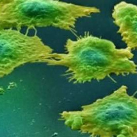 Células afectadas por cáncer de colon