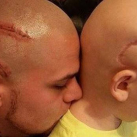 Josh Marshall (izquierda) y su hijo Gabriel Marshall (derecha) con la misma cicatriz.