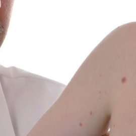 Bebé con sarampión, en una imagen de archivo. EFE