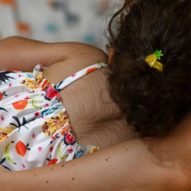 Un bebé con hipertricosis | EFE
