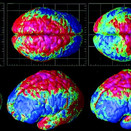 Depresión, esquizofrenia, autismo y trastorno bipolar son más similares de lo que sus síntomas indican