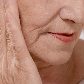 Las arrugas en la cara mueven miles de millones de euros anuales en el mundo.-MEDSCAPE