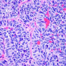 Imagen de archivo de una metástasis en el pulmón. FLICKR/PULMONARY PATHOLOGY