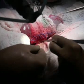 Se trasplanta con éxito el riñón de cerdo a una mujer en muerte cerebral