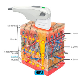 Una nueva tecnología basada en ultrasonidos permite hacer 'liftings' sin cirugía