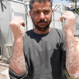 El sirio Omar Isa muestra en sus brazos el brutal eccema que tiene por todo el cuerpo y denuncia falta de asistencia médica y de tratamiento. / M.I