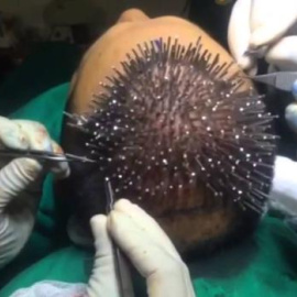 Turquía se ha convertido en la nueva meca del turismo capilar de bajo coste. /YOUTUBE