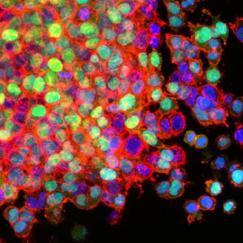 Células de cáncer de pulmón en proceso de metástasis, invadiendo los tejidos circundantes. / National Cancer Institute/Winship Cancer Institute of Emory University
