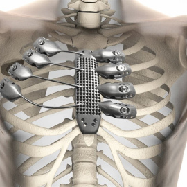 Implantan una caja torácica y un esternón elaborados con una impresora 3D
