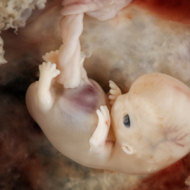 Embrión de siete semanas. / lunar caustic