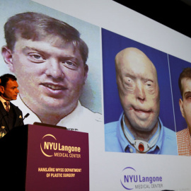 El doctor Eduardo Rodríguez presenta los resultados del trasplante. REUTERS/Mike Segar
