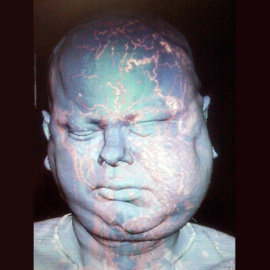 Vall d'Hebron realiza con éxito un segundo trasplante de cara