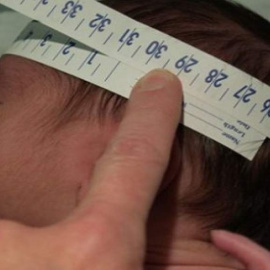 Alerta de microcefalia en Brasil