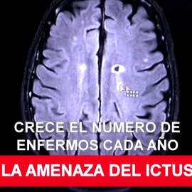 Ictus: primera causa de mortalidad en las mujeres y la tercera en los hombres