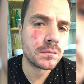 Dani Martín comparte un problema de piel con sus seguidores