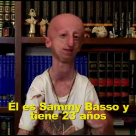Sammy Basso, el joven con progeria que ha investigado sobre su propia enfermedad