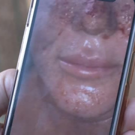 Andrea, víctima de la 'clínica del terror' de Marbella: "Hace nueve años me destrozó la cara"