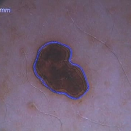 Moderna anuncia para 2030 una vacuna contra el cáncer de piel