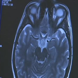 Una pastilla para frenar el tumor cerebral que mató a Seve Ballesteros