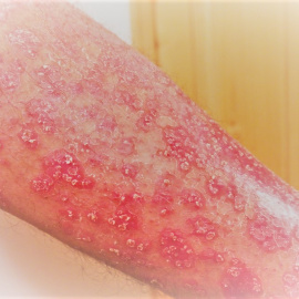 La psoriasis es una enfermedad inflamatoria cutánea de carácter autoinmune que provoca el desprendimiento e infección de la piel causando dolor e hinchazón