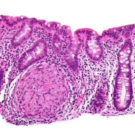 Biopsia endoscópica donde se puede apreciar inflamación granulomatosa del colon en un caso de enfermedad de Crohn. WIKIPEDIA