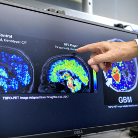 Imagen de una radiografía cerebral en un paciente de alzhéimer.