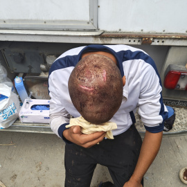 Un hombre con una brecha en la cabeza en el campamento de El Trampolín.