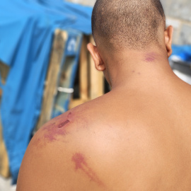 Un hombre con lesiones en la espalda en el campamento de Naves del Tarajal.