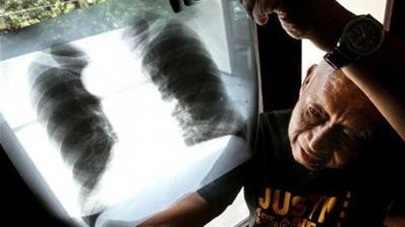 En la imagen, un hombre enfermo de cancer enseña la radiografía de sus pulmones. EFE