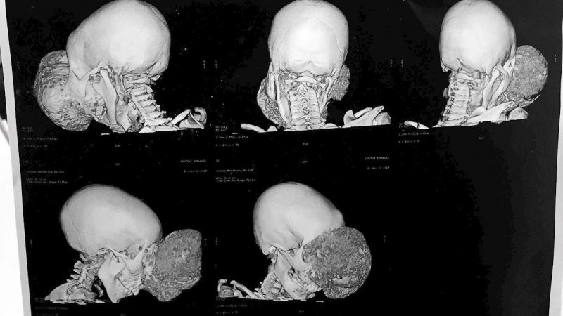 El tumor cráneo facial no maligno formaba una masa mas grande que su propia cabeza a Emmanuel | EFE