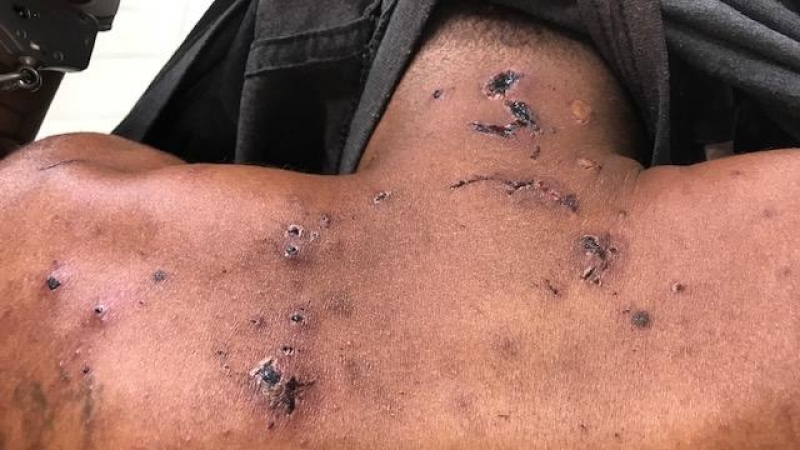 Marcas de tortura en uno de los detenidos por el Ejército brasileño en el caso de la Sala Roja. DEFENSORÍA PÚBLICO DEL ESTADO DE RÍO DE JANEIRO.