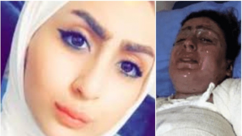 Malak Haider Al Zubaidi, antes y después de ser quemada por su marido en Irak.