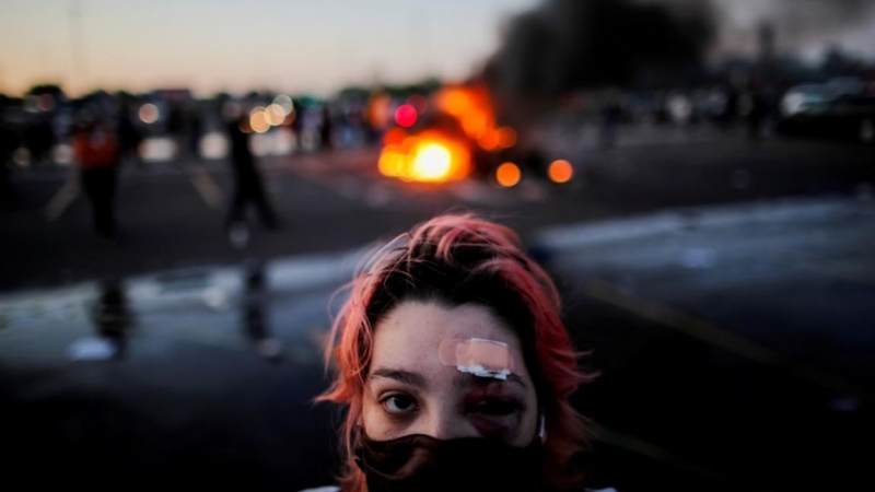 Rachel Pérez es fotografiada con moretones alrededor de los ojos y un yeso en la frente, heridas sufridas por balas de goma durante las protestas de ayer, mientras se encontraba a cierta distancia de un vehículo en llamas en el estacionamiento de una tien