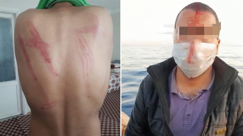 Izquierda: hematomas tras haber sido golpeado por las autoridades griegas durante la expulsión desde el campo de Diavata el 15-16 de abril.-BORDER VIOLENCE MONITORING NETWORK Derecha: hombre herido en la operación del 29 de mayo cerca de la isla de Lesbos