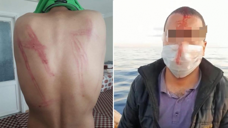 Izquierda: hematomas tras haber sido golpeado por las autoridades griegas durante la expulsión desde el campo de Diavata el 15-16 de abril.-BORDER VIOLENCE MONITORING NETWORK Derecha: hombre herido en la operación del 29 de mayo cerca de la isla de Lesbos